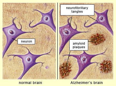 Hình ảnh bệnh học não người bình thường và người mắc bệnh Alzheimer