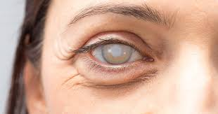 5 biện pháp giúp phòng ngừa biến chứng tiểu đường ở mắt hiệu quả