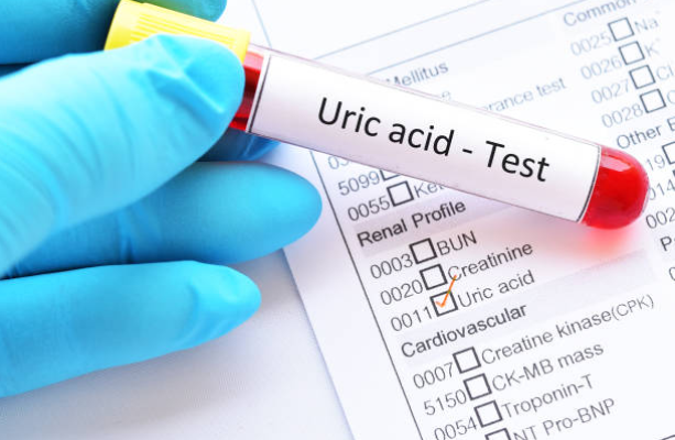Người bệnh gút có acid uric trong máu tăng cao bất thường