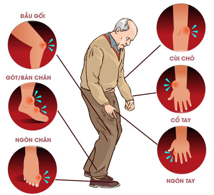 Gout đa khớp khiến bệnh nhân đau ở nhiều khớp khác nhau