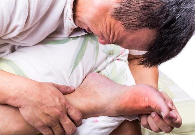 Bệnh Gout có nguy hiểm không? Các cách phòng ngừa biến chứng bệnh Gout