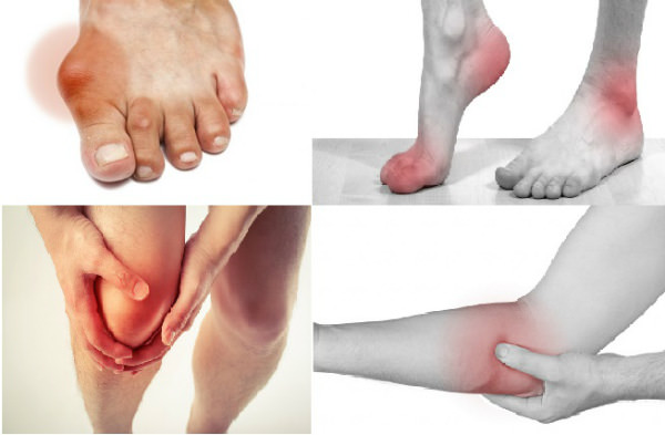 Cơn gút cấp gây đau đớn ở các khớp chân, khớp tay