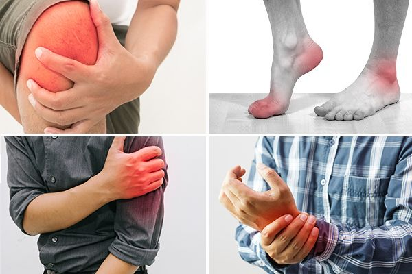 Triệu chứng sưng, nóng, đỏ, đau các khớp ở người bệnh khi gặp cơn gút cấp