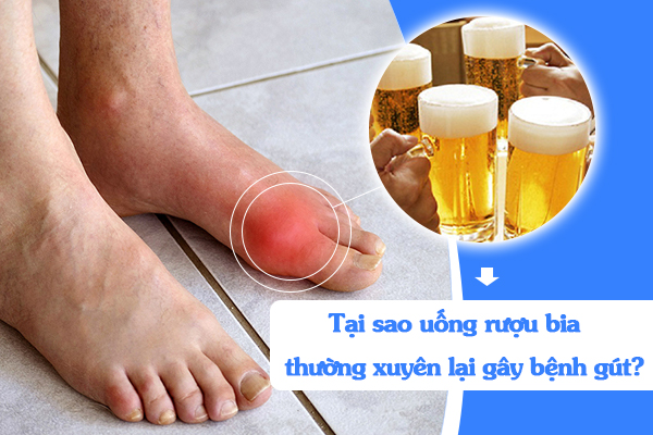 Tại sao uống rượu bia thường xuyên lại gây bệnh gút?