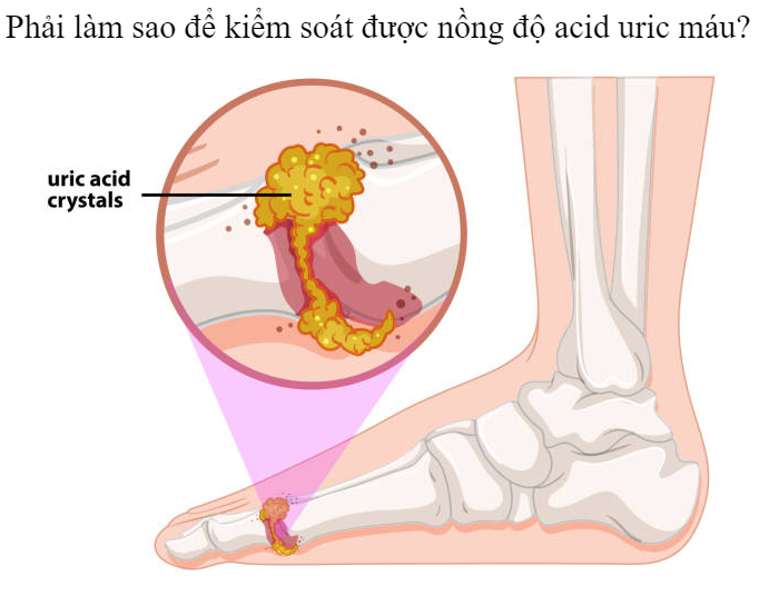 Kiểm soát nồng độ acid uric máu bằng cách nào?