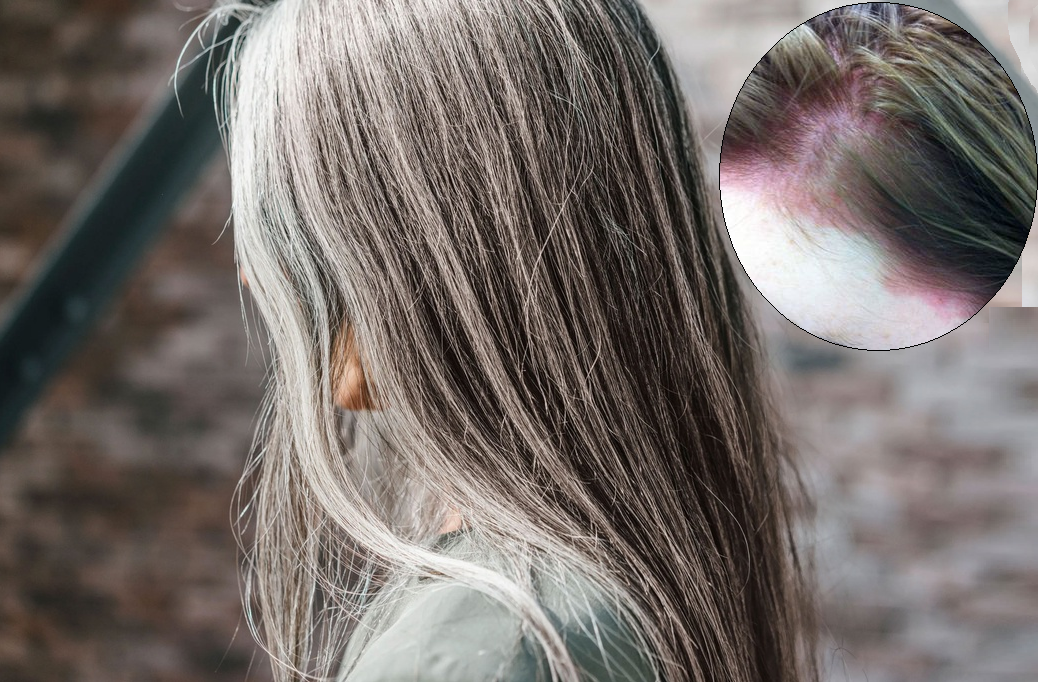 Dị ứng với thuốc nhuộm - Người tóc bạc phải làm sao?