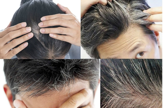 Biện pháp khắc phục tình trạng bạc tóc sớm hiệu quả là gì?