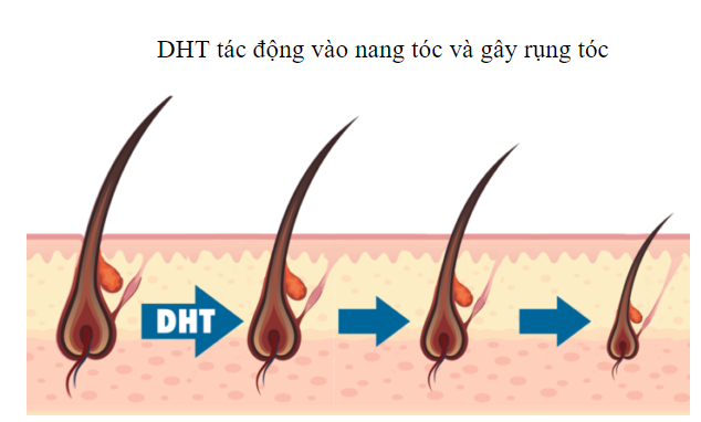 DHT là nguyên nhân rụng tóc phổ biến nhất