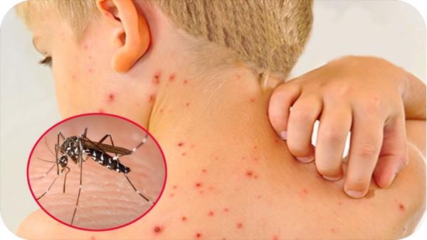 Muỗi vằn là trung gian truyền bệnh sốt xuất huyết ở trẻ em.