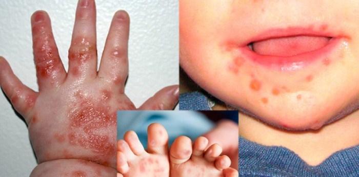 3 Dấu hiệu cảnh báo bệnh tay chân miệng của trẻ đang ở giai đoạn nặng cần nhập viện