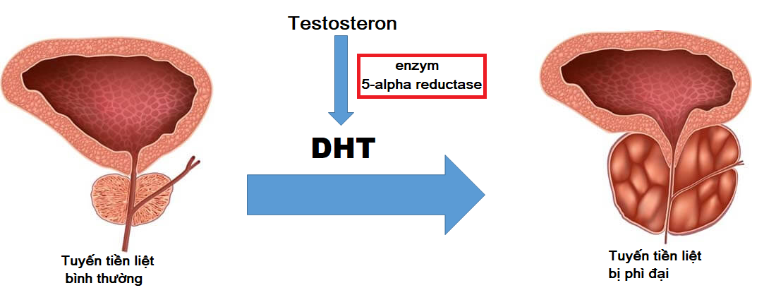 Tăng sinh DHT là nguyên nhân gây u xơ tiền liệt tuyến