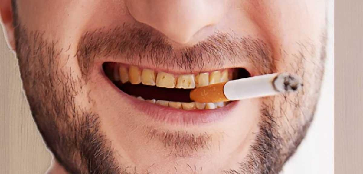 Hút thuốc lá lâu ngày khiến răng vàng, miệng hôi