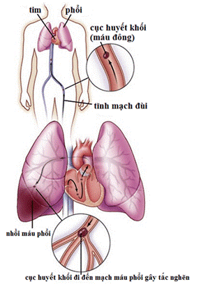 Huyết khối tĩnh mạch gây thuyên tắc phổi