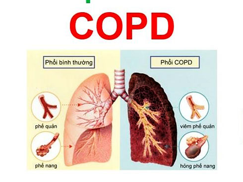 Điều trị bệnh phổi tắc nghẽn mạn tính COPD