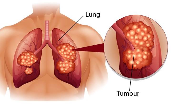 Ô nhiễm không khí – nguyên nhân chính gây ung thư phổi