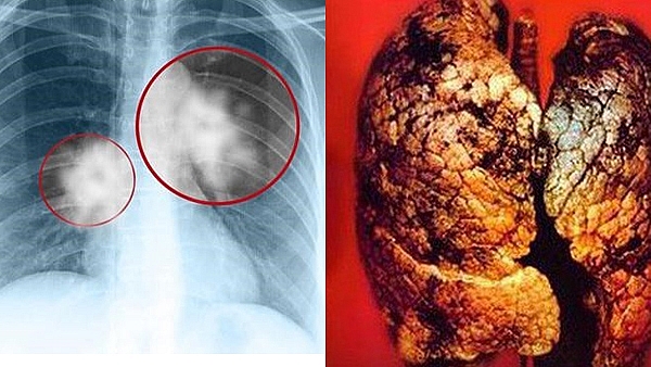 Ung thư phổi là bệnh có sự xuất hiện của các tế bào phân chia và tăng sinh bất thường tạo thành khối u ác tính trong phổi