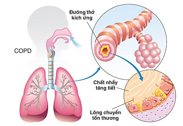 Những triệu chứng và xét nghiệm giúp bác sĩ chẩn đoán bệnh phổi tắc nghẽn mãn tính COPD