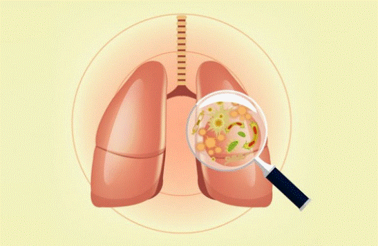 Khi nào cần hỗ trợ giải độc phổi? 