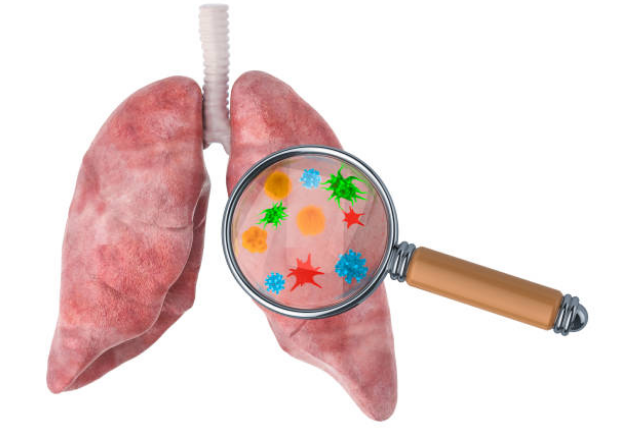 Nhiễm độc phổi là con đường dẫn đến viêm phế quản mạn tính