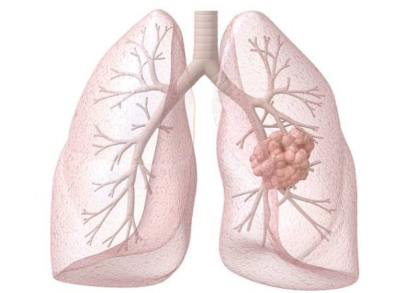 Hít khói bụi trong thời gian dài làm khiến bạn đối mặt với bệnh ung thư phổi