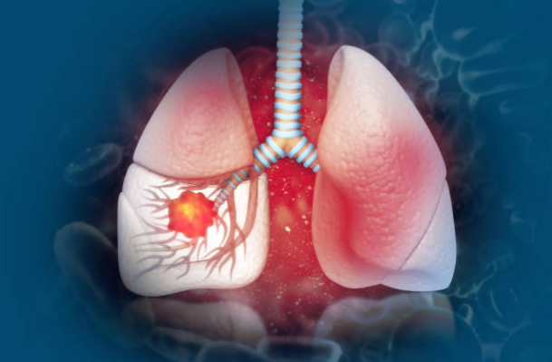 Ung thư phổi là một trong những bệnh lý nguy hiểm nhất của phổi
