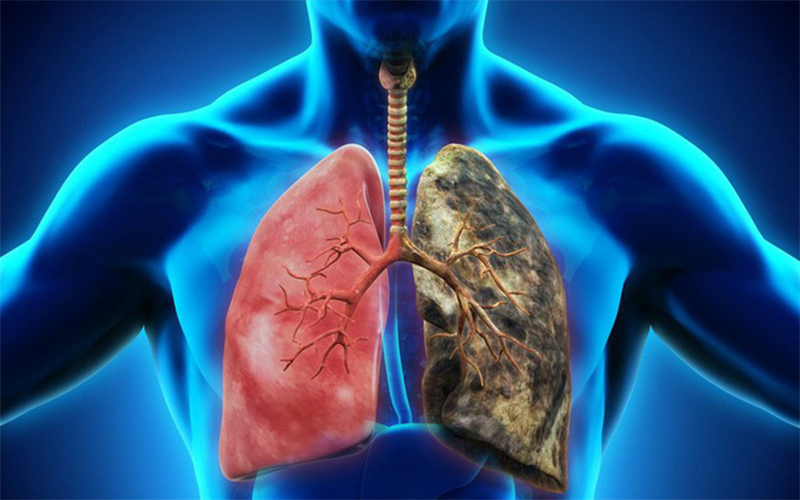 Ung thư phổi là biến chứng vô cùng nguy hiểm ở người bệnh COPD.