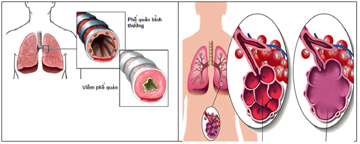 Bệnh viêm phế quản mãn tính (bên trái) và bệnh giãn phế nang (bên phải)