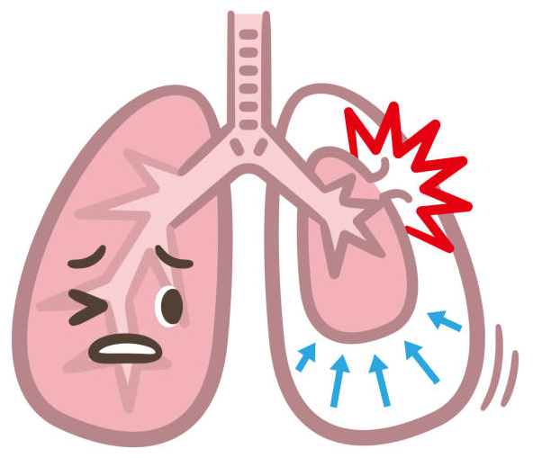 Người bệnh COPD có nguy cơ cao bị tràn khí màng phổi