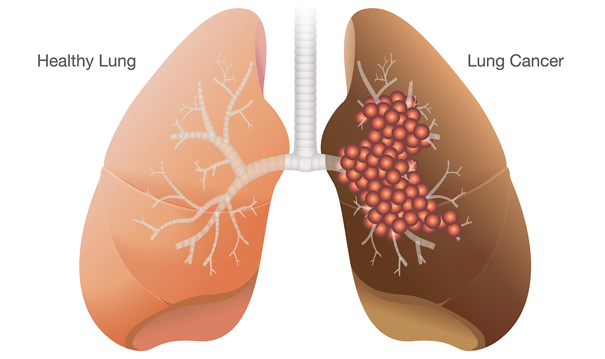  Khó thở về đêm có thể tiềm ẩn bệnh ung thư phổi