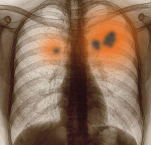 Bệnh bụi phổi silic gây tổn thương không hồi phục