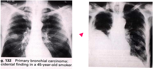 Lá phổi bị ung thư do hút thuốc lá 45 năm.