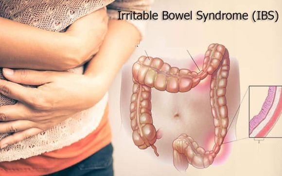 Hội chứng ruột kích thích IBS là nguyên nhân hàng đầu gây hiện tượng ăn xong đau bụng đi ngoài