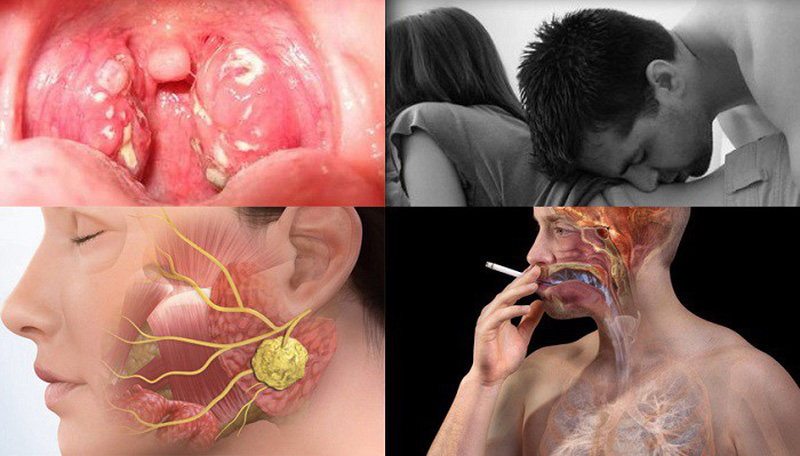 Có thể bạn không biết, quan hệ bằng miệng có thể gây ung thư vòm họng