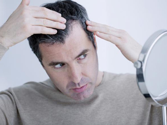 Tìm hiểu về chứng rụng tóc ở nam giới