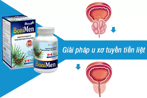 BoniMen - Sự lựa chọn hoàn hảo cho người bệnh u xơ tuyến tiền liệt