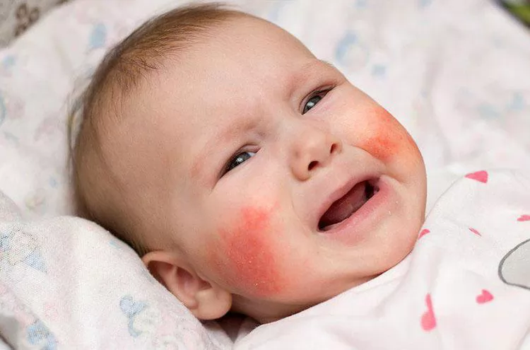 Trẻ bị dị ứng thời tiết phải làm sao?