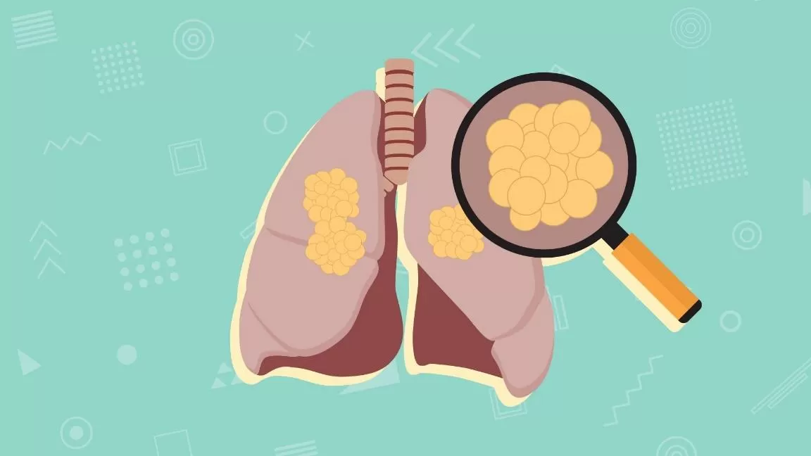Tại sao không hút thuốc lá vẫn bị ung thư phổi? Giải pháp giúp giảm nguy cơ ung thư phổi hiệu quả