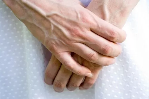 Mặc cảm khi bị suy giãn tĩnh mạch tay