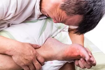 Cơn gút cấp khiến người bệnh đau đớn vô cùng