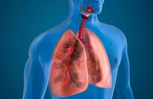 Tìm hiểu về các loại điều trị bệnh phổi tắc nghẽn mãn tính COPD