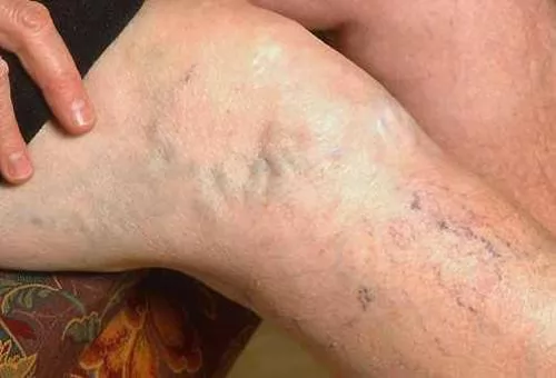 Tác hại của bệnh suy giãn tĩnh mạch chân