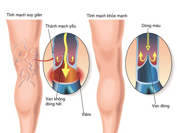 Triệu chứng suy giãn tĩnh mạch là gì? Giải pháp tối ưu cải thiện suy giãn tĩnh mạch