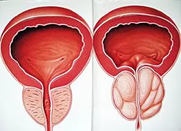 Hỏi: Bệnh phì đại lành tính tuyến tiền liệt có biến chứng không?