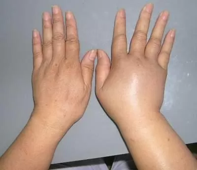 bệnh tê phù do rượu