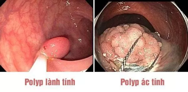 Polyp đại tràng càng lớn thì càng dễ tiến triển thành ác tính.