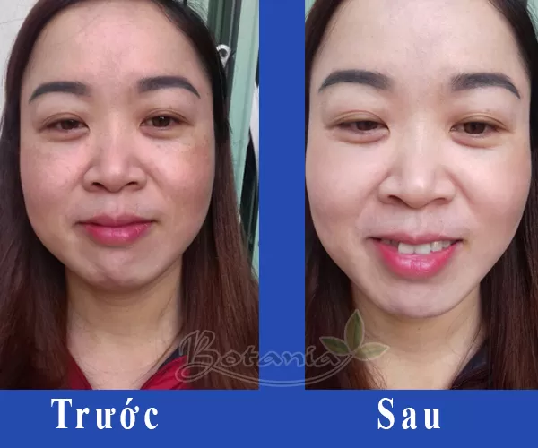 Da nám, nhăn nheo đã có cách đơn giản từ BoniSnow