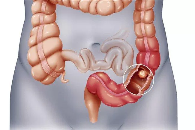 Viêm đại tràng đi ngoài ra máu có thể dẫn tới ung thư đại tràng
