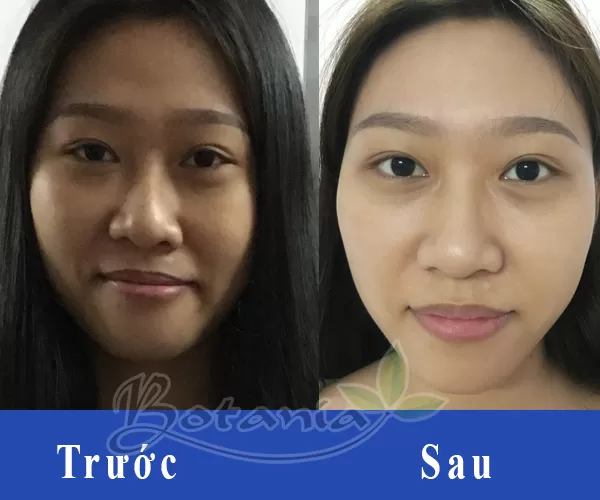 Da có nhiều vết thâm, sần sùi và ngăm đen, yên tâm nhé các nàng vì đã có BoniSnow!
