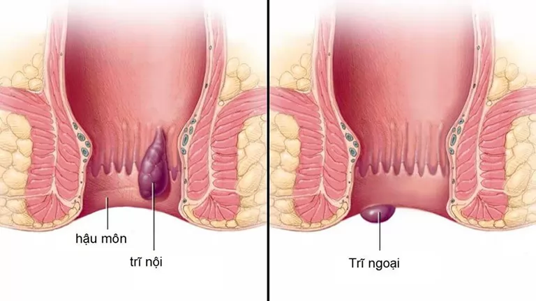 Bệnh trĩ nội: khó nhận biết sớm, dễ tiến triển gây biến chứng nặng
