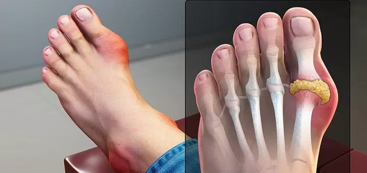 Biểu hiện điển hình của bệnh nhân Gout